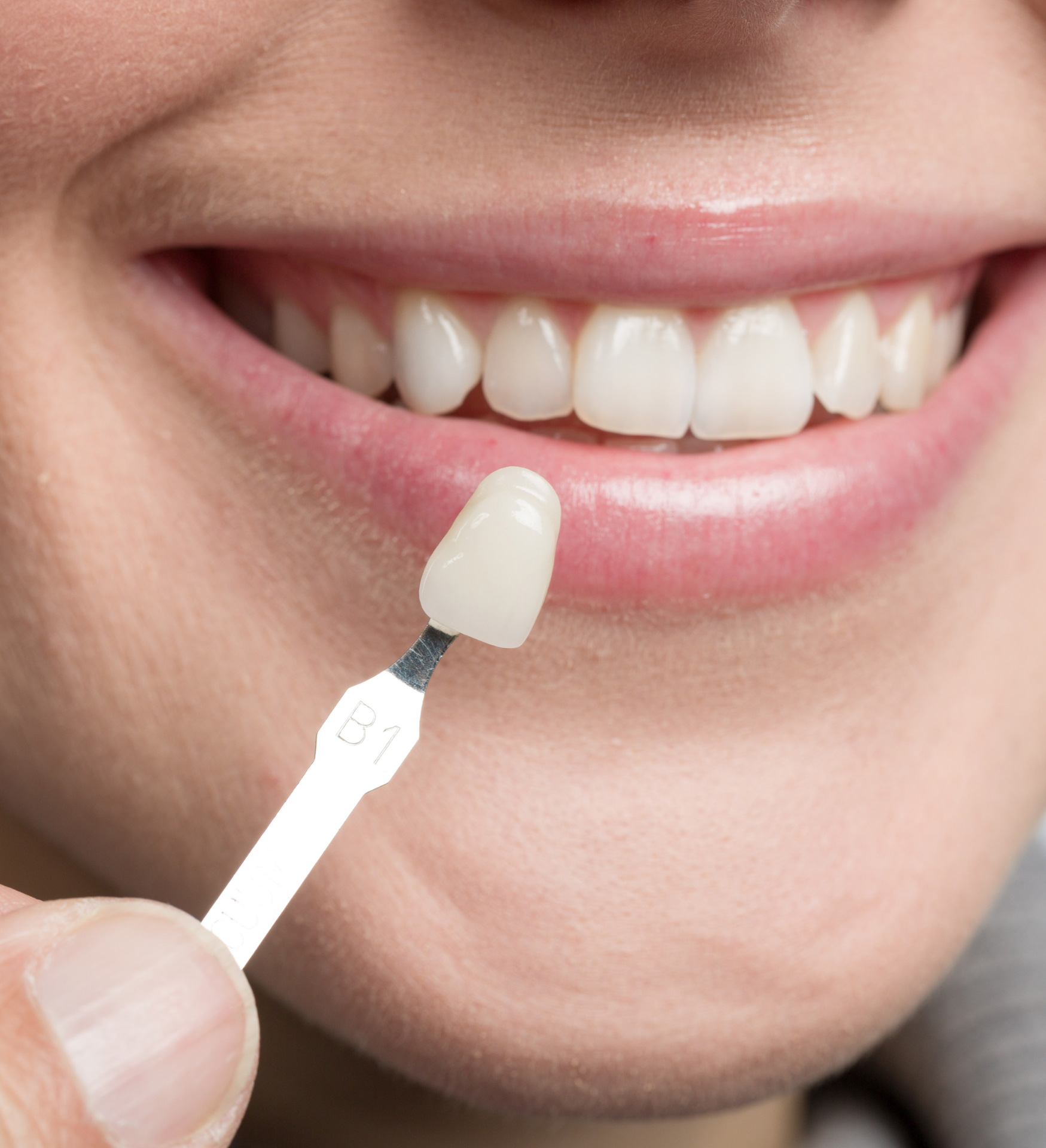 Όψεις πορσελάνης